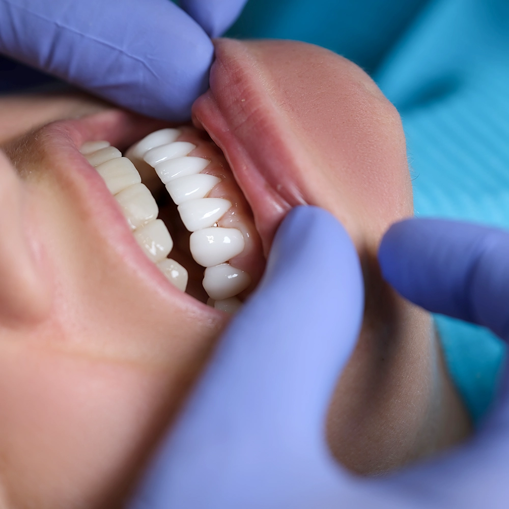 Close-up of a smile with blue-gloved hands gently lifting the bottom lip to show the teeth.