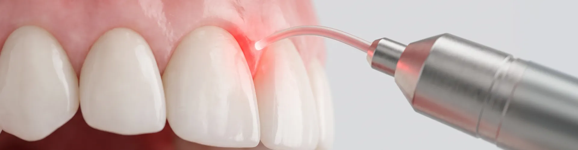 Close-up of cosmetic gum contouring using a dental laser to reshape the gumline around the front teeth.