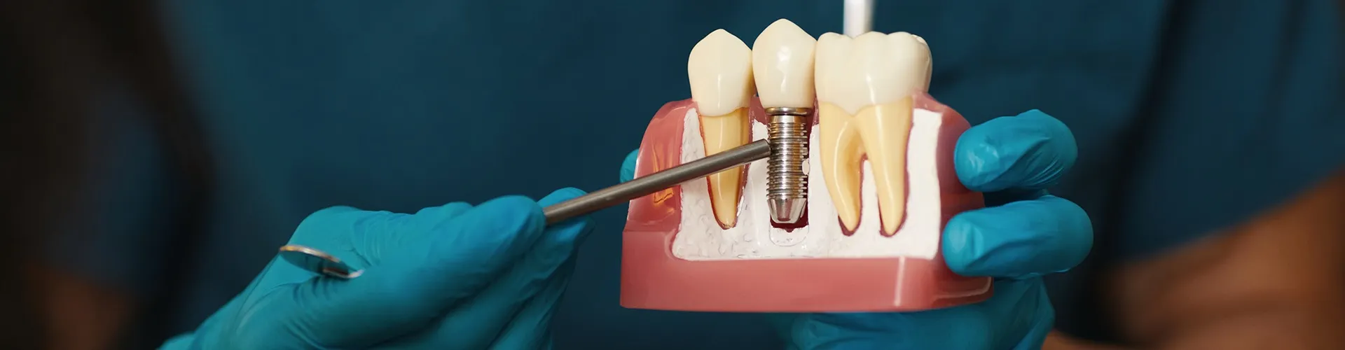 gloved hands holding a dental implant model