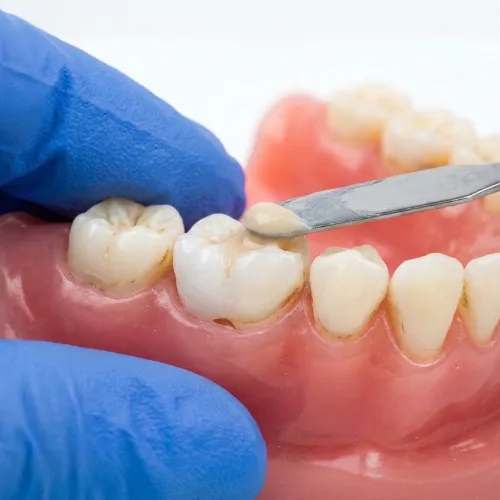 Gloved hands placing granules into tooth cavity in model jaw.