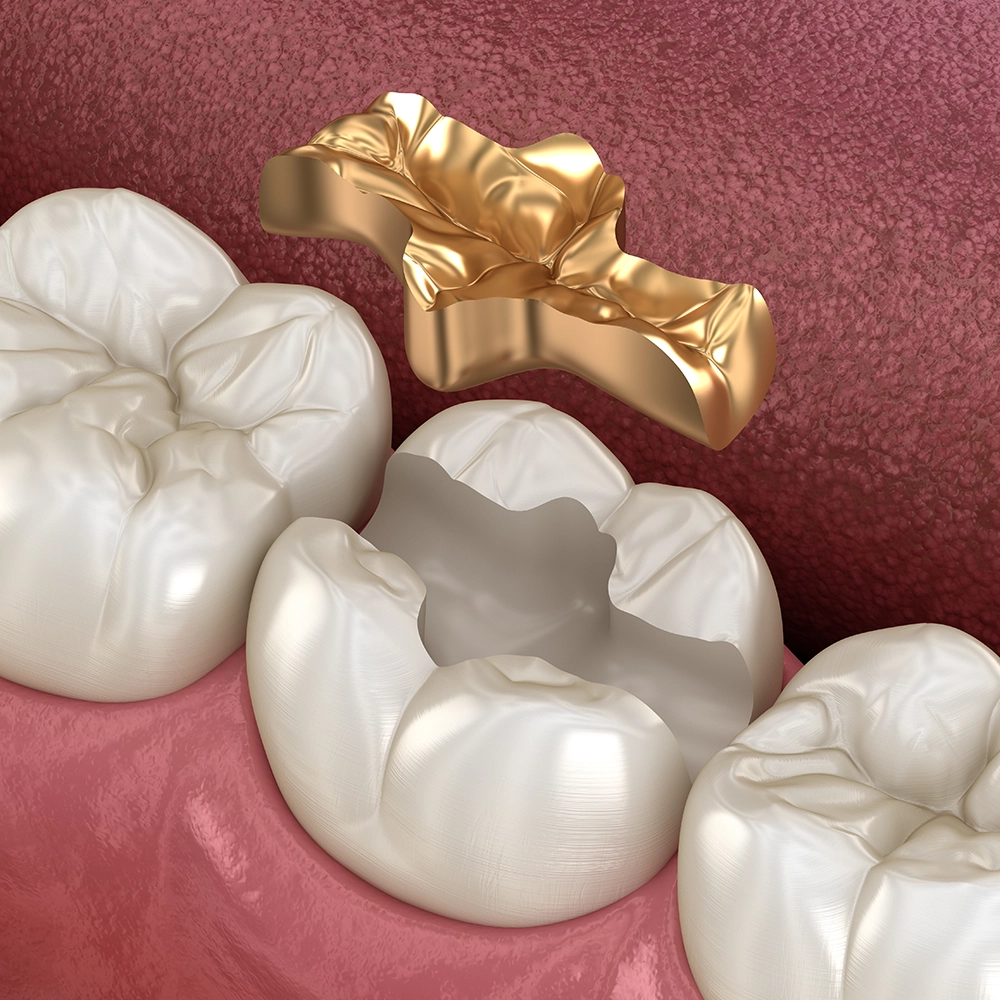 3D rendering of three molars, with gold fillings.