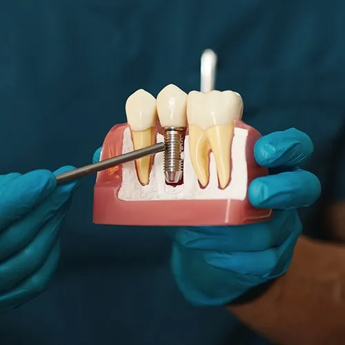 gloved hands holding a dental implant model