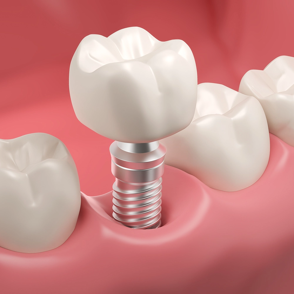 3D rendering of a dental implant being placed into the gum.