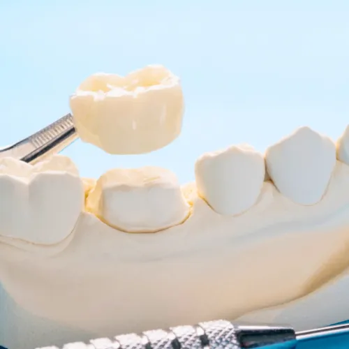 Tweezers placing crown on plaster jaw model.