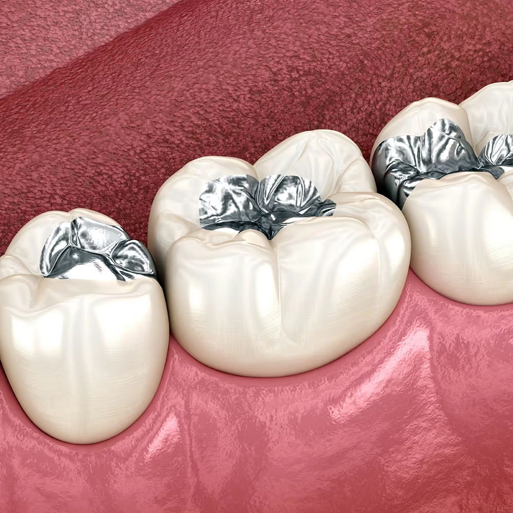 3D rendering of three molars, each with silver (amalgam) fillings.
