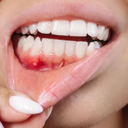 Woman pulling down bottom lip to show inflamed gum.