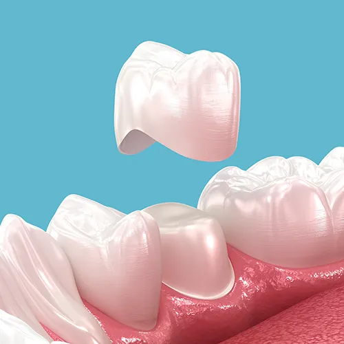 rendering of a white dental crown hovering above a filed-down tooth