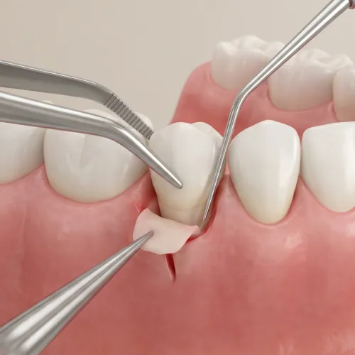 Dental rendering showing gum recession treatment option like gum grafting.