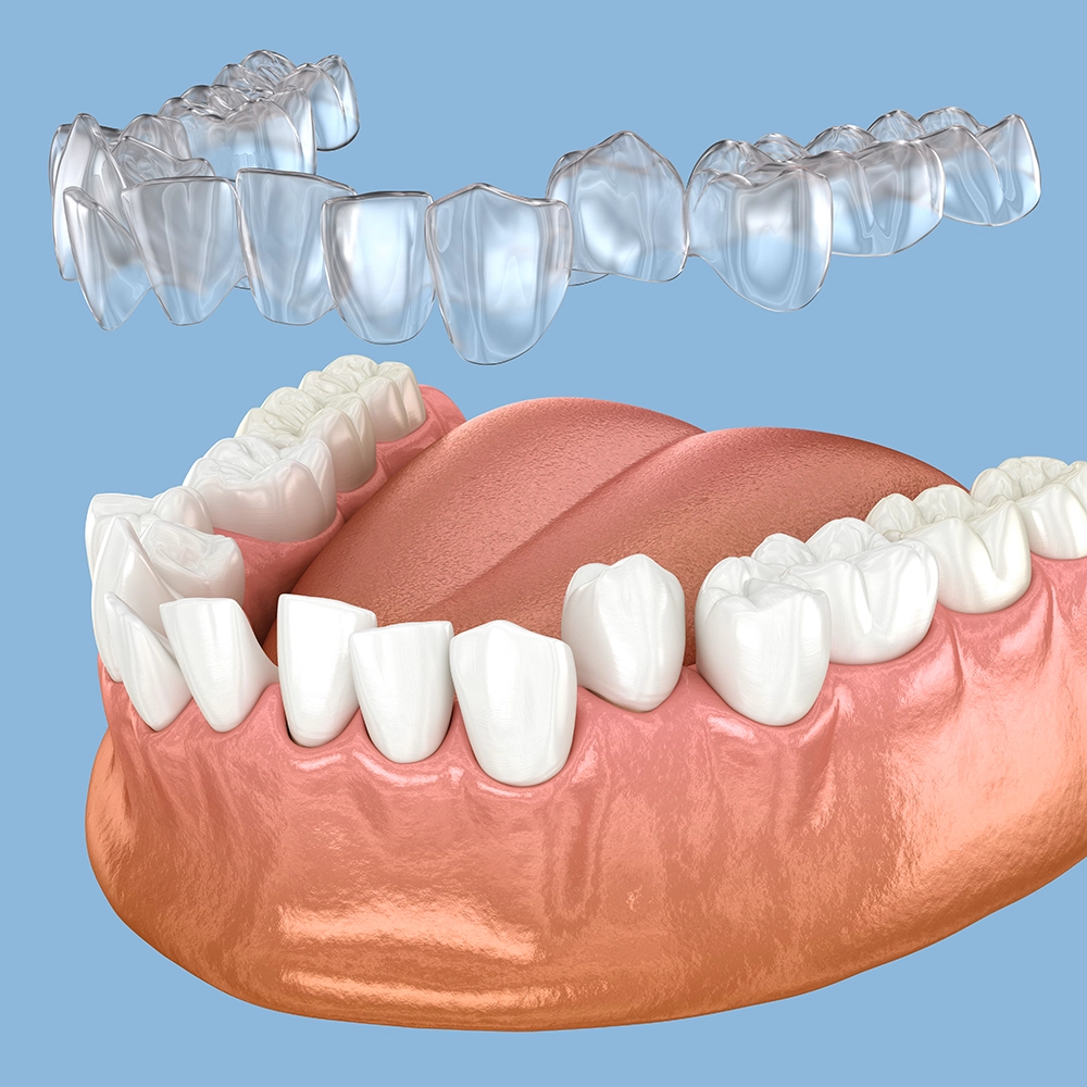 3D rendering of lower teeth with a clear aligner (Invisalign) floating above them against a bluish background.