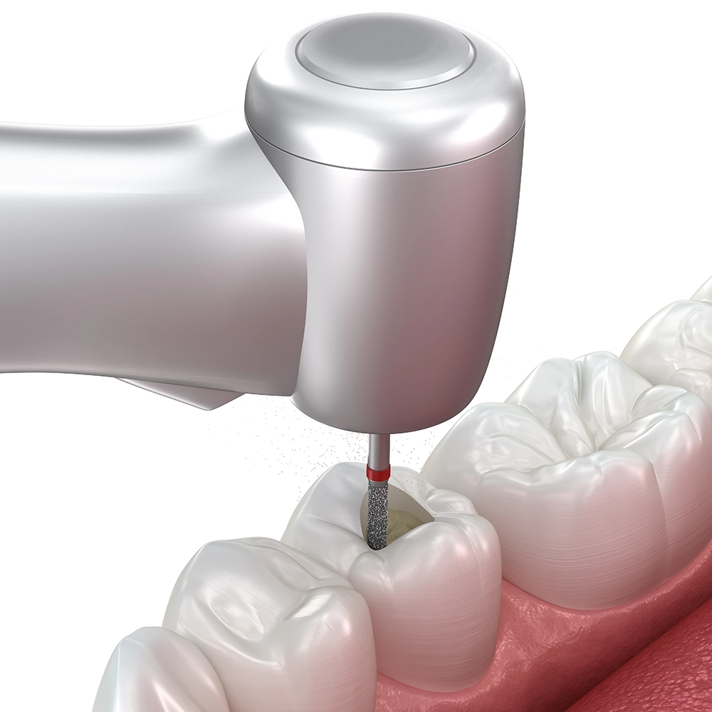 3D rendering of a tooth being drilled for a root canal procedure.