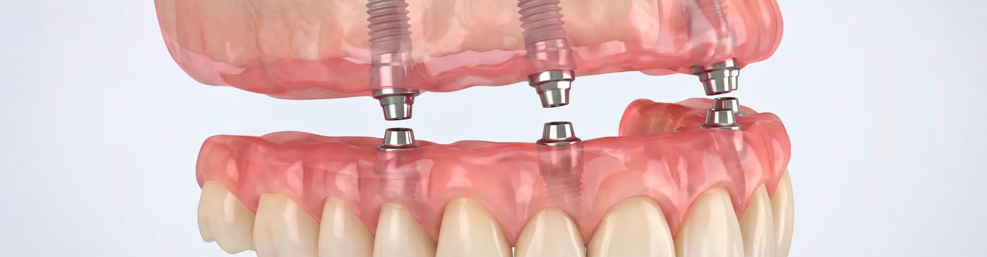 Rendering of a denture being attached to 4 dental implants in the upper gum.