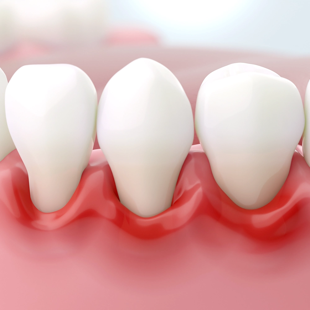 3D rendering of three teeth with red, inflamed gums.