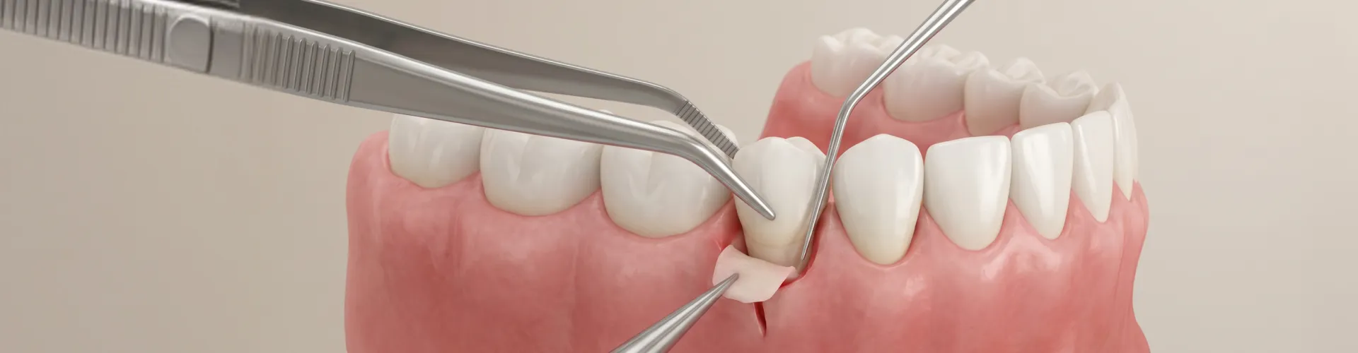 Dental rendering showing gum recession treatment option like gum grafting.