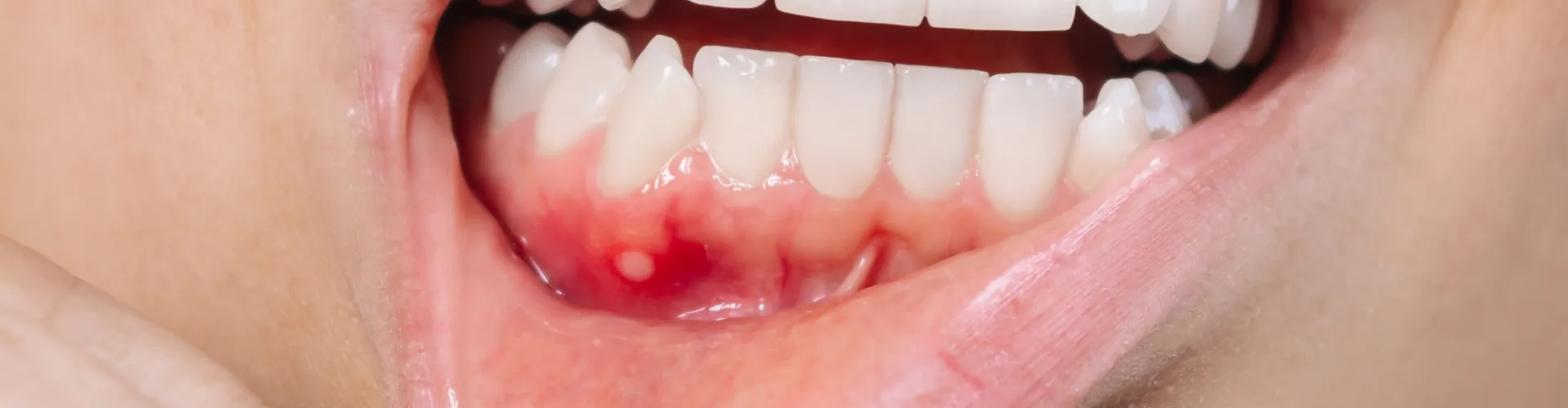 Woman pulling down bottom lip to show inflamed gum.