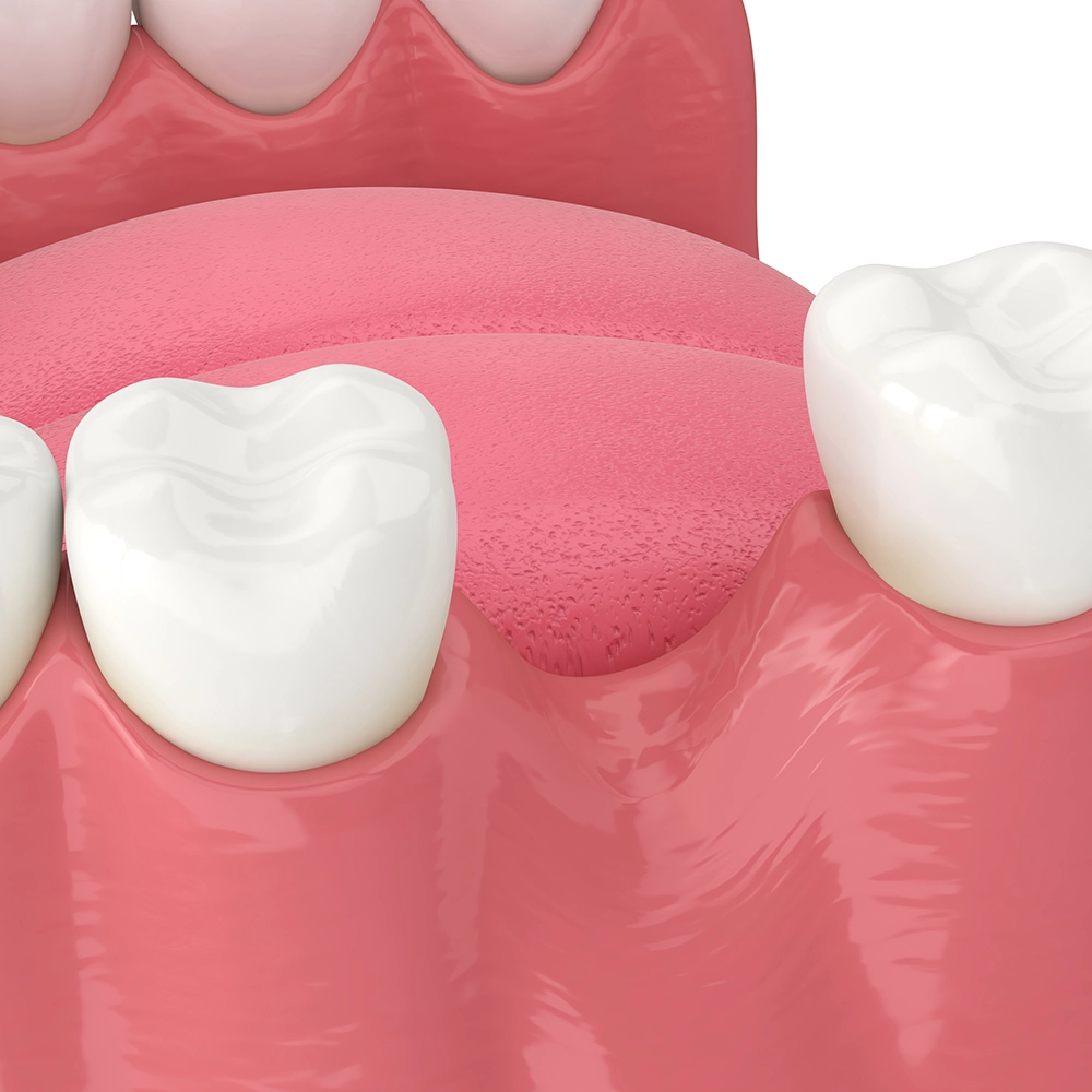 3D rendering of molars with a missing tooth in the middle, showing an extraction gap.