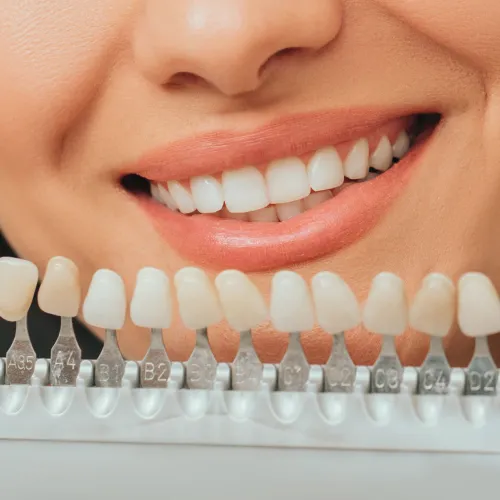 Tooth shade-matching tool in front of woman's smile.