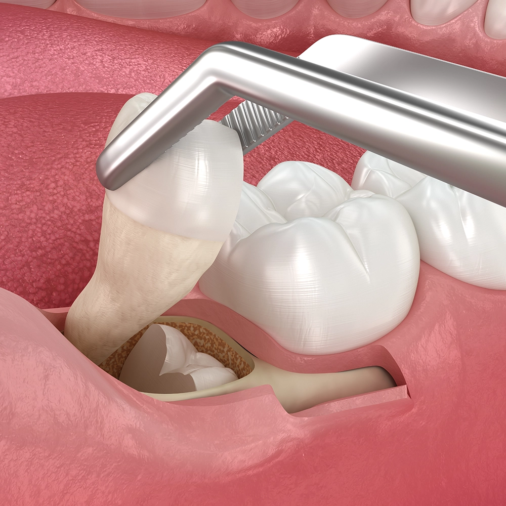 3D rendering of a tooth fragment being held with tweezers during extraction.