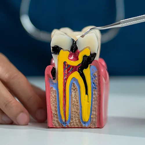 Hand holding model of a tooth with decay.