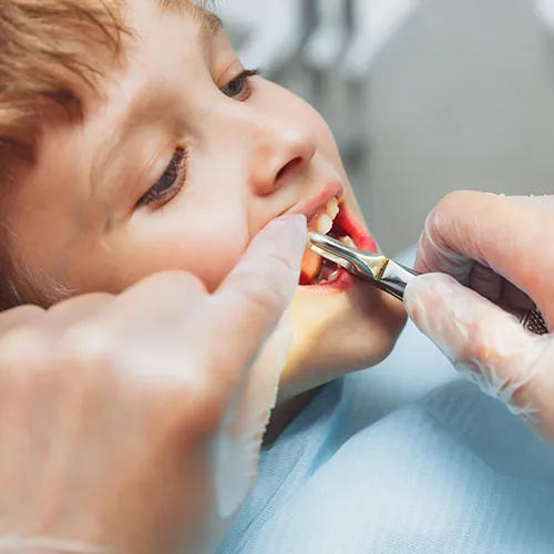 Gloved hands using dental pliers to pull child's tooth.