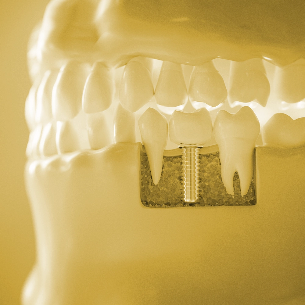 Yellow-toned 3D rendering of a mouth showing three teeth, with the middle tooth as a dental implant.