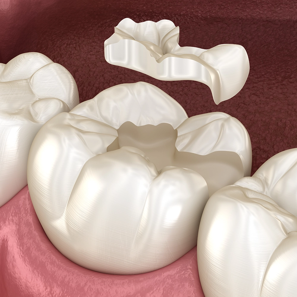 3D rendering of a molar with resin filling.