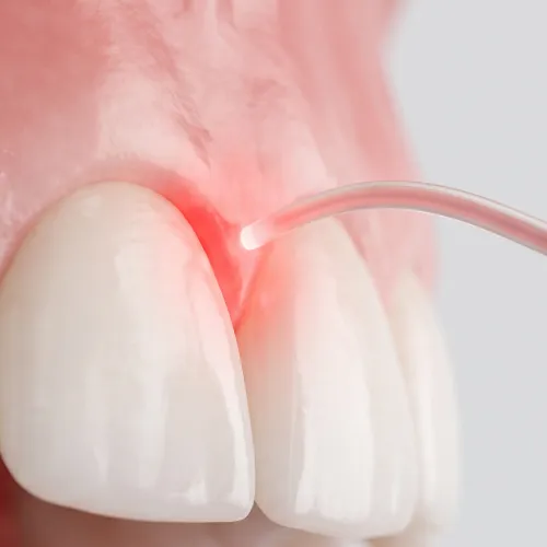 Close-up of cosmetic gum contouring using a dental laser to reshape the gumline around the front teeth.