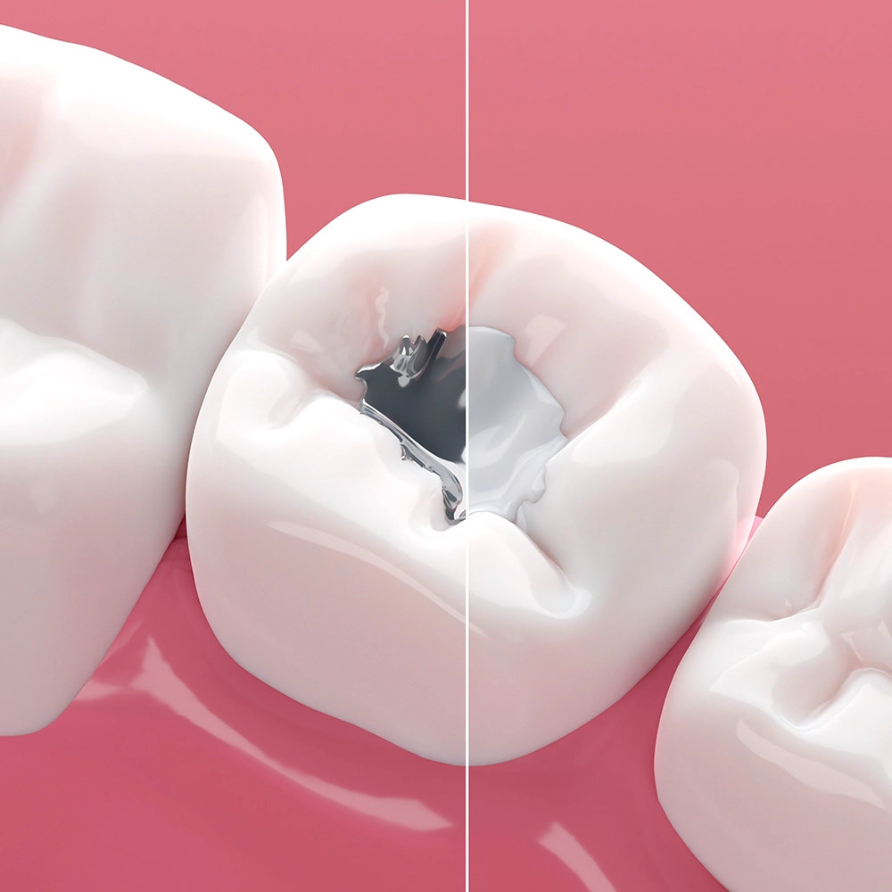 3D rendering of a molar showing one side with an amalgam filling and the other side with a resin filling, highlighting the difference.