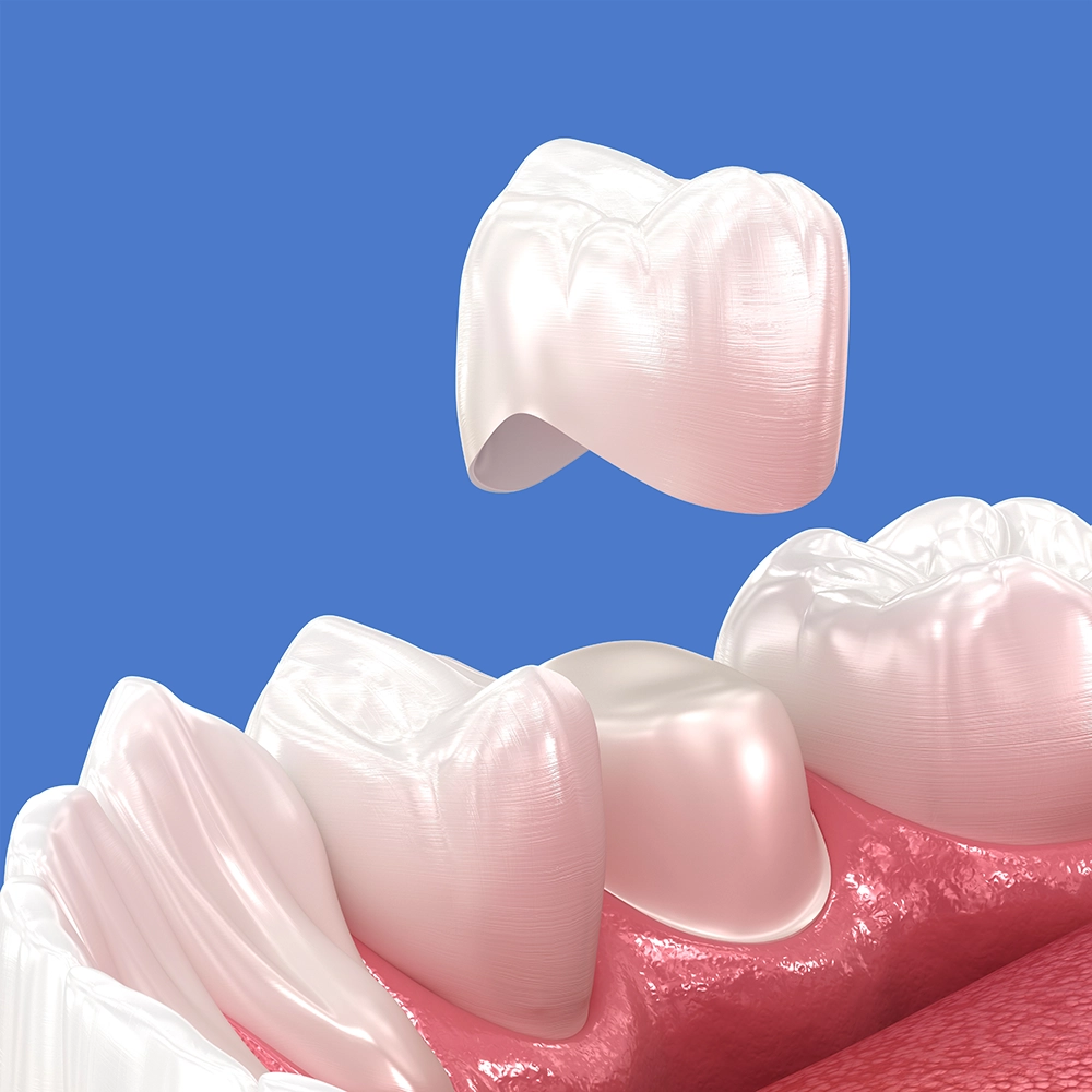 3D rendering of a dental crown being placed on a tooth.