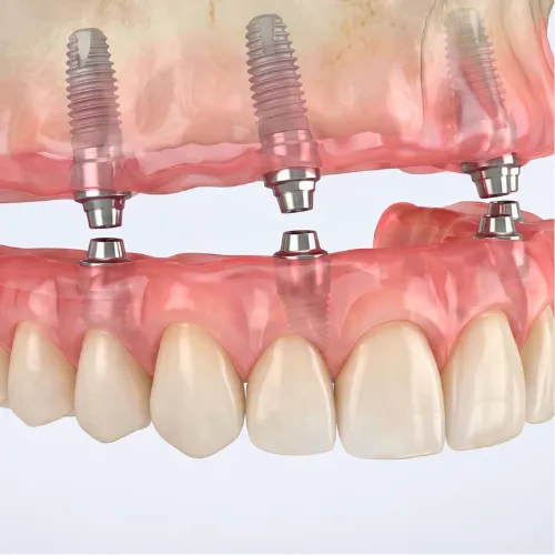 Rendering of a denture being attached to 4 dental implants in the upper gum.