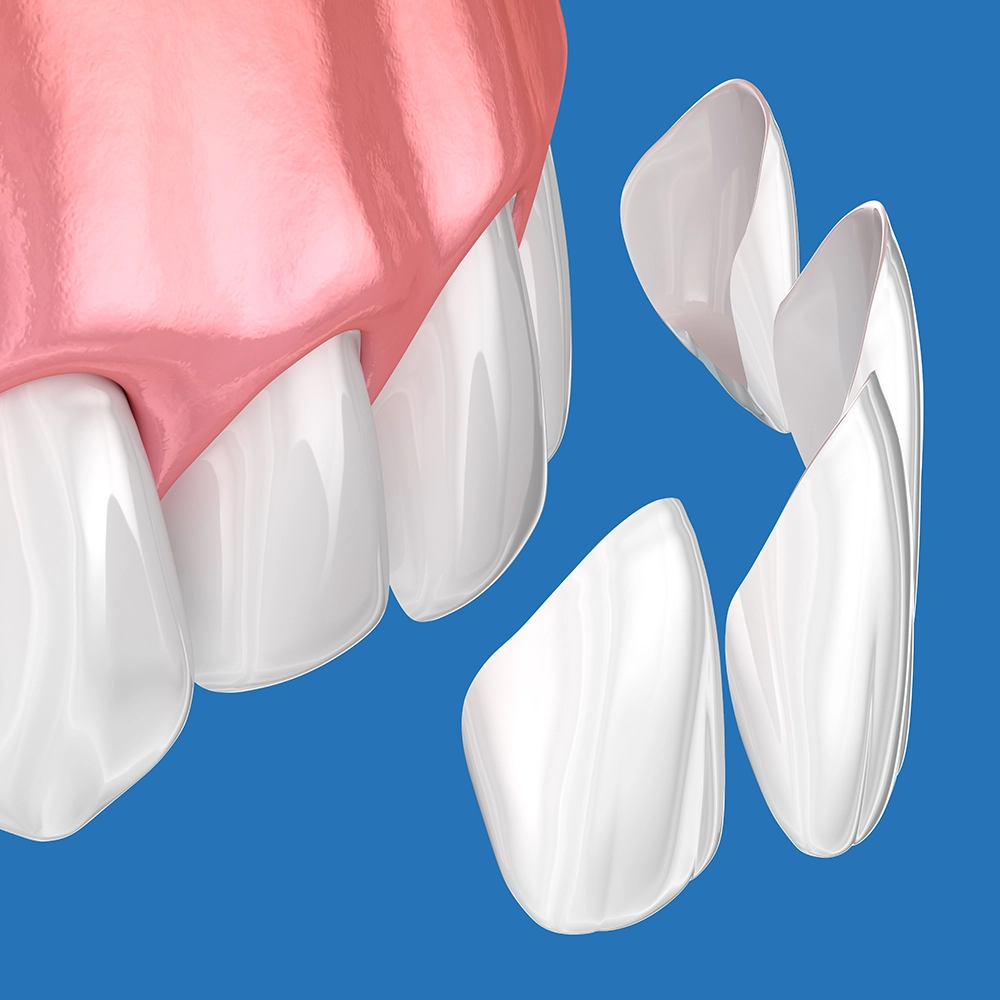 3D rendering of teeth with veneers on the front teeth against a blue background.