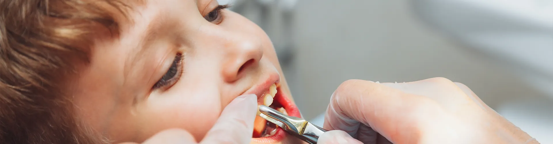 Gloved hands using dental pliers to pull child's tooth.
