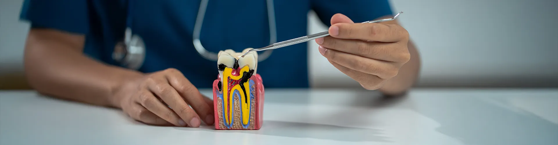 Hand holding model of a tooth with decay.