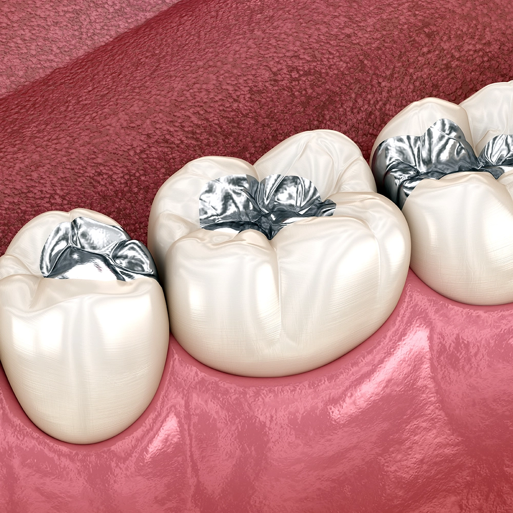3D rendering of three molars, each with silver (amalgam) fillings.