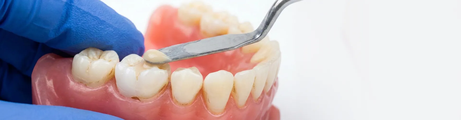 Gloved hands placing granules into tooth cavity in model jaw.