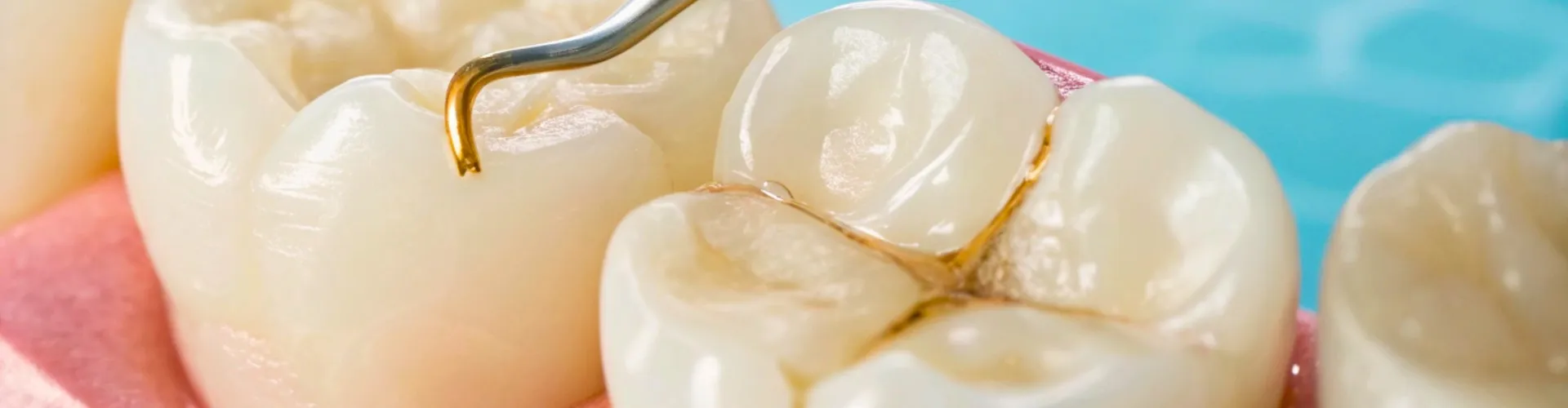 Model of teeth with cavities.