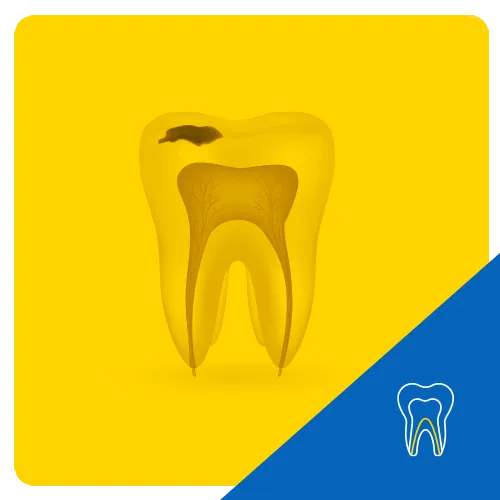 3D depiction of a tooth with exposed roots and a visible cavity on top, set against a yellow background to illustrate tooth decay.