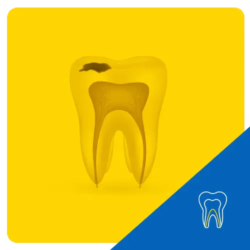 3D depiction of a tooth with exposed roots and a visible cavity on top, set against a yellow background to illustrate tooth decay.