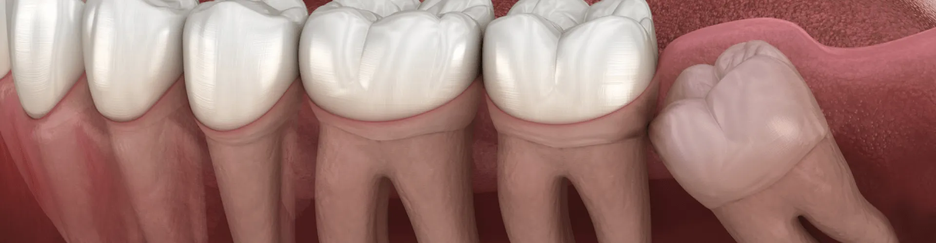 Rendering of an impacted wisdom tooth in the bottom jaw.