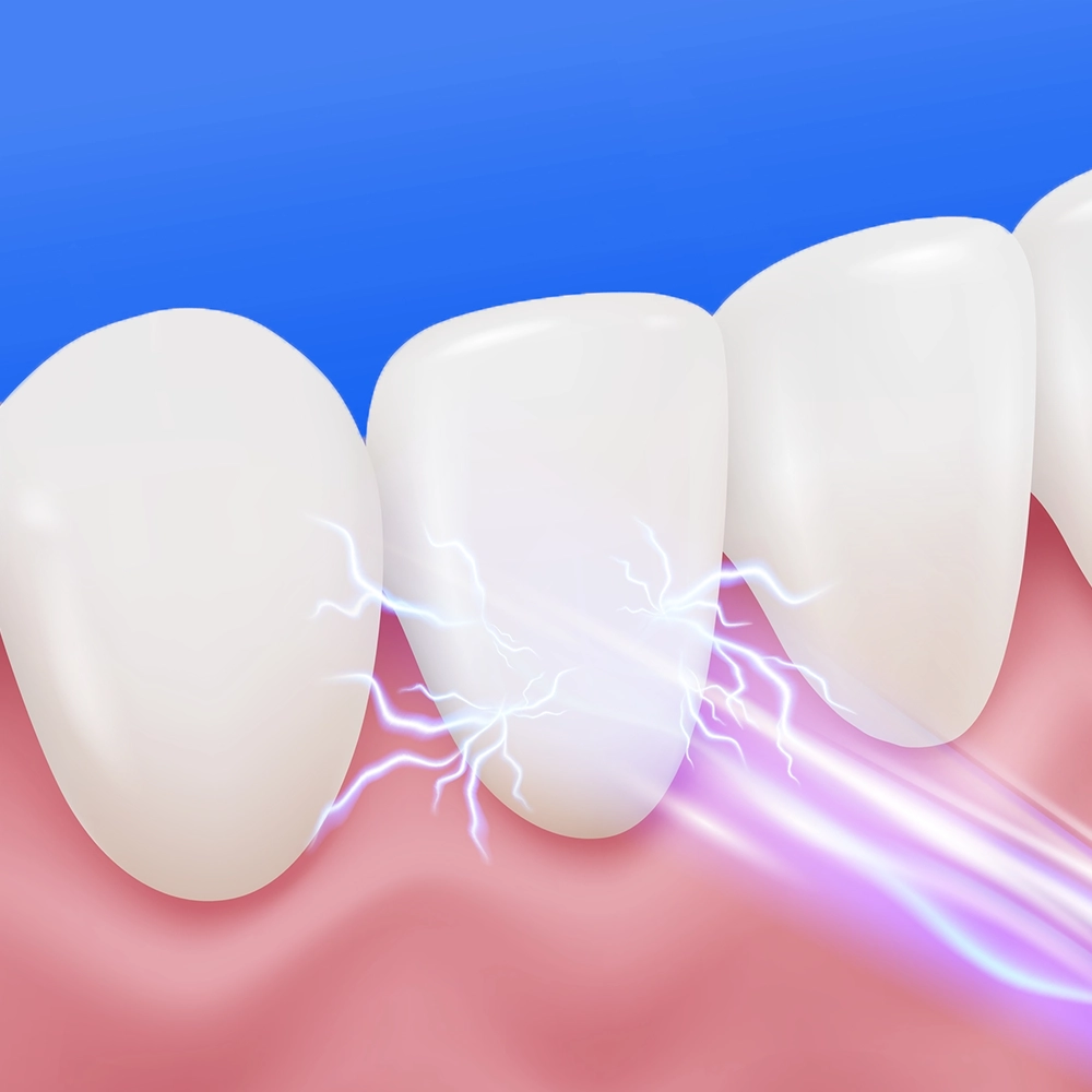 3D rendering of a tooth being struck by electric-like lines, representing severe pain.