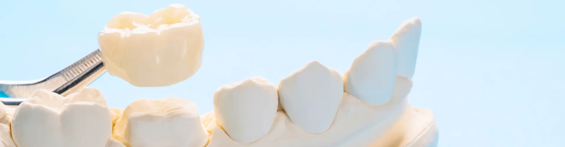 Tweezers placing crown on plaster jaw model.