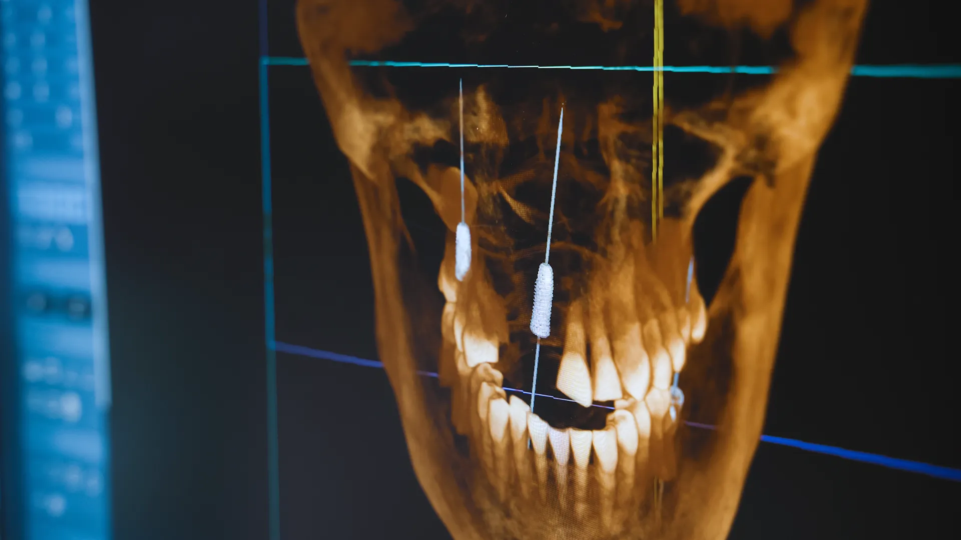 Dental X-ray image showing a screw inside a tooth or jaw, likely part of a dental implant.