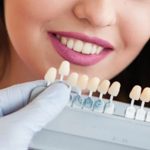 Dentist holding a shade guide to match dental veneers for a patient smile makeover.