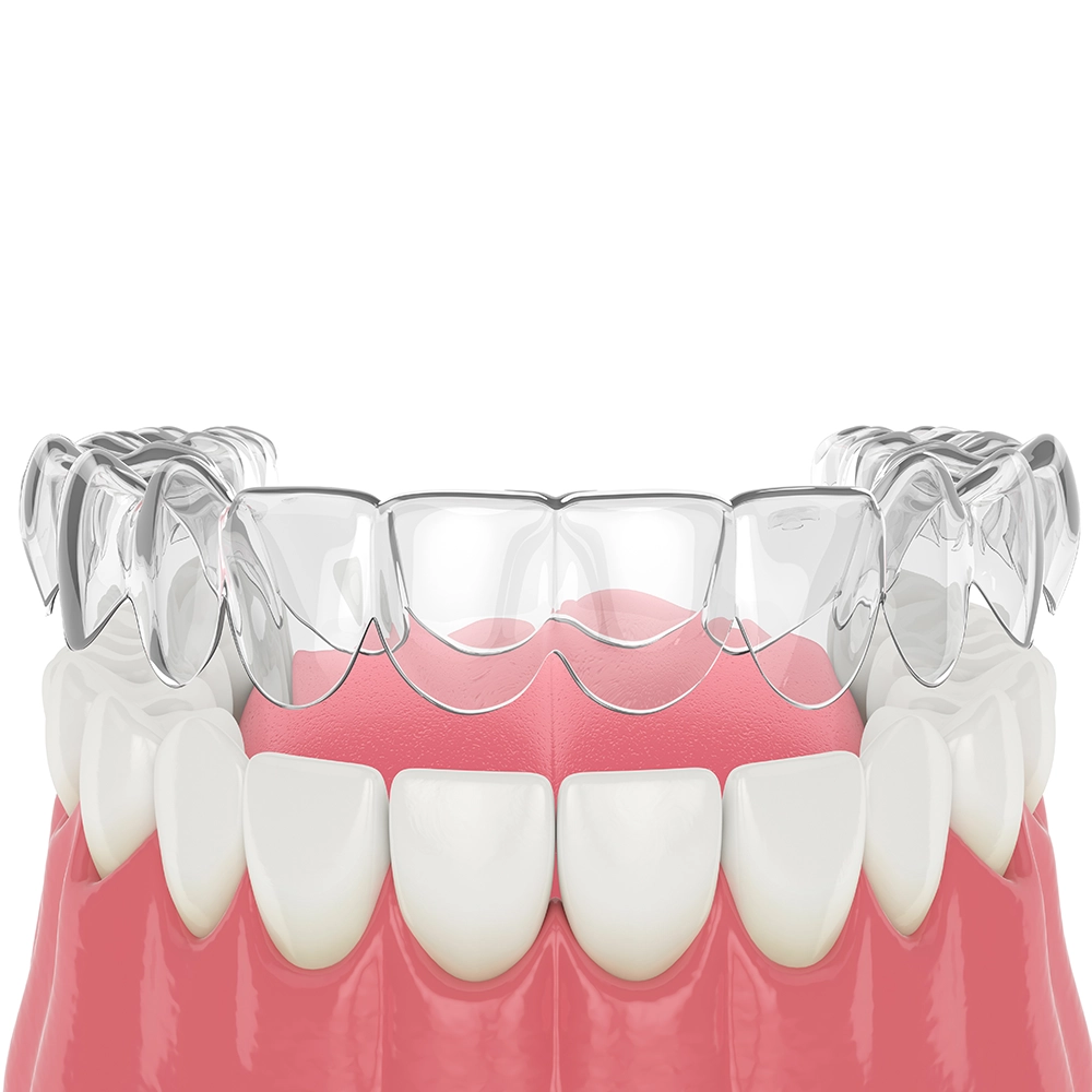 3D rendering of teeth with clear aligners positioned above them on a white background.